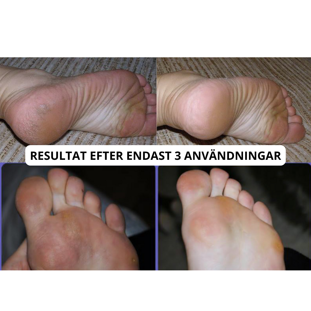 SilkyHeel™ | Elektrisk häl och hudförnyare
