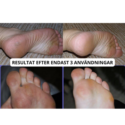 SilkyHeel™ | Elektrisk häl och hudförnyare